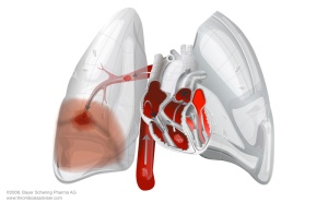 lungs-pulmonary-embolism-cu