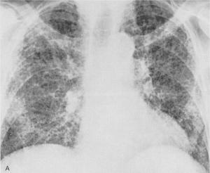 Rx_fibrosis_pulmonar